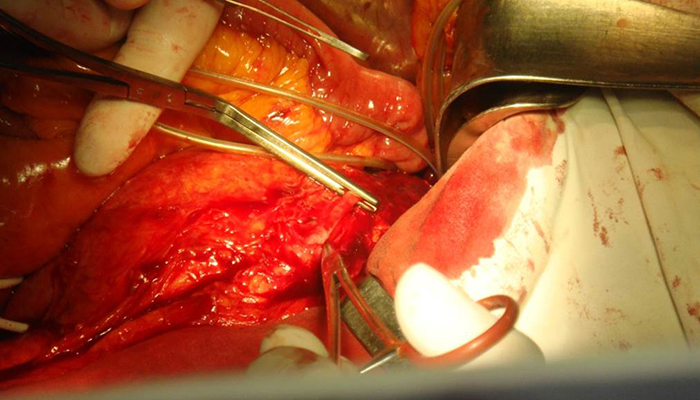 «Իզմիրլյան» բժշկական կենտրոնում ուշագրավ վիրահատություն նորաբաց Անոթային վիրաբուժության բաժանմունքում
